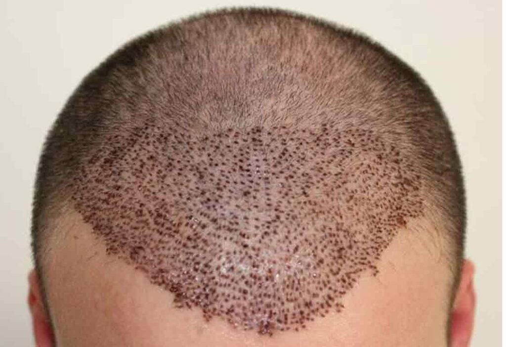 Can Working Out Cause Hair Loss