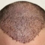Modern Hair Transplants