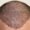 Trichophytic Closure in Hair Transplants
