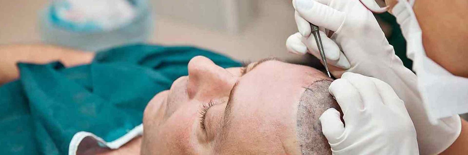 Modern Hair Transplants