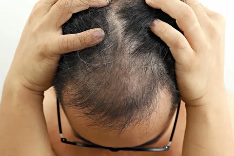 7 grade hair loss