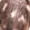 alopecia areata specialist