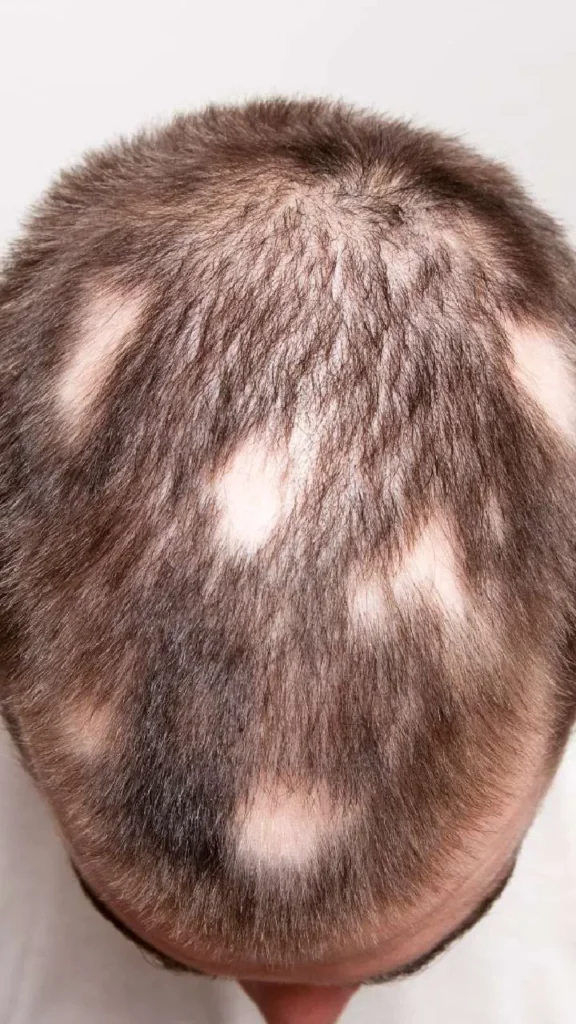 Hair Specialist for Alopecia