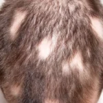 can alopecia areata be reversed