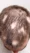 can alopecia areata be reversed