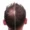  potential side effects of hair cloning