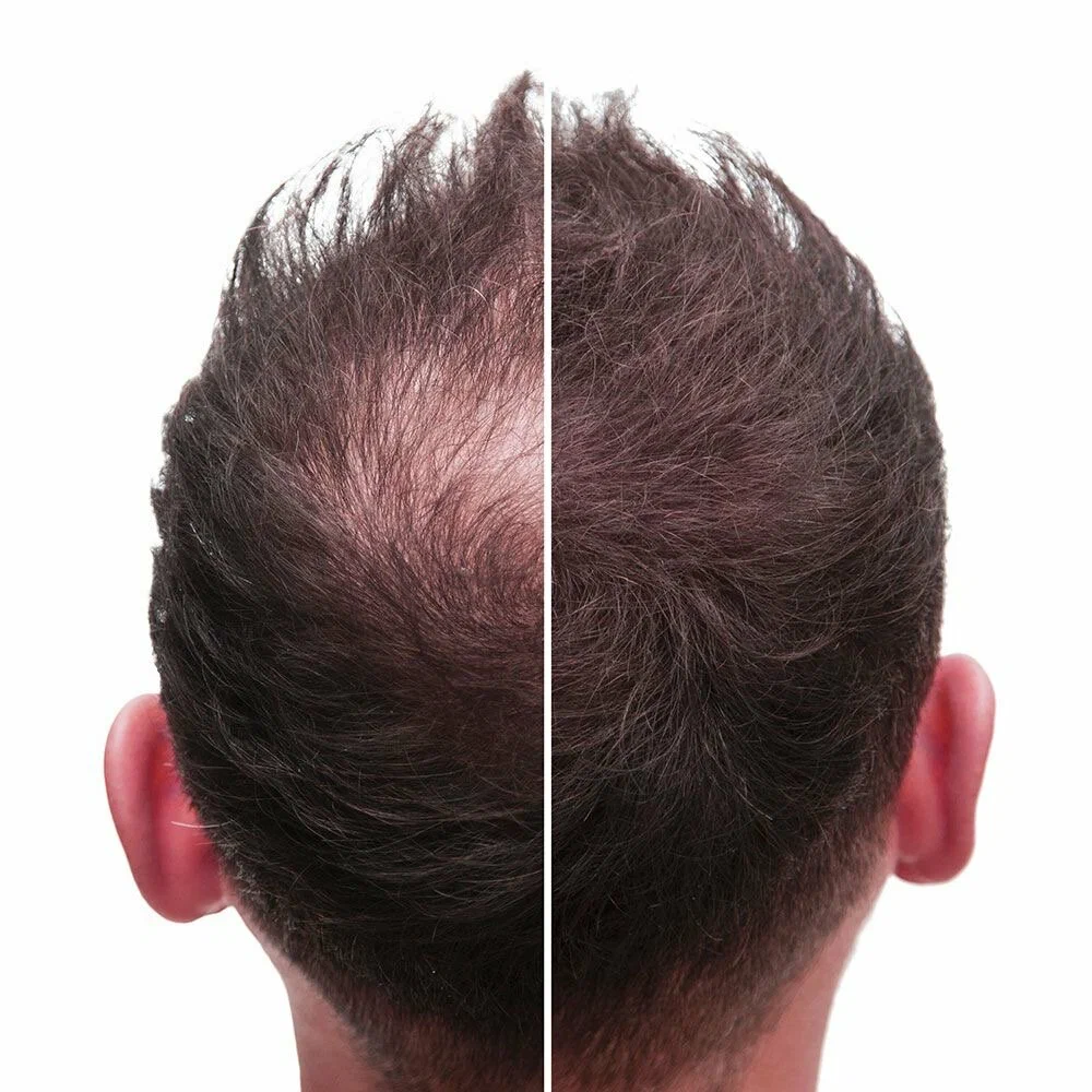 potential side effects of hair cloning