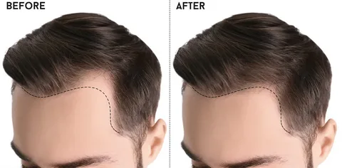 Can I Regrow My Receding Hairline