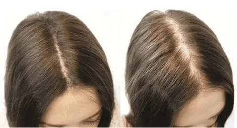 Can Your Thin Hair Become Thick Again