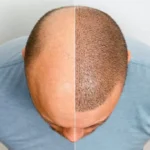 Can hair grow back after thinning male