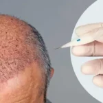Good Hair Transplant