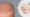 Before and after results of male hair restoration – Can a man really get his hair back with FUE or PRP treatment in Islamabad?