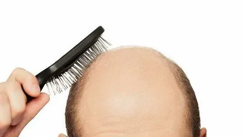 Worried man with visible hair loss wondering: Can a man really get his hair back through modern hair restoration treatments?
