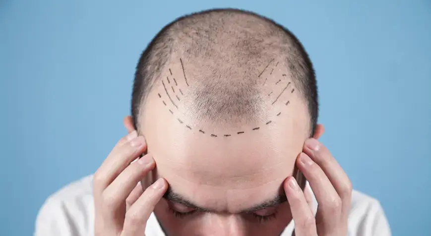 Can hair grow back after thinning male