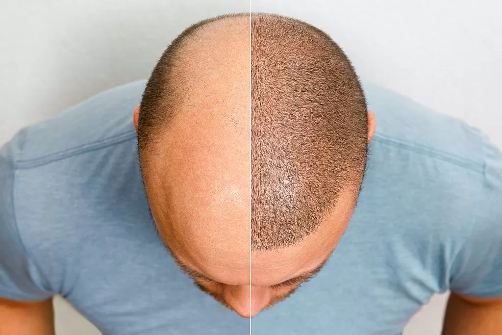 Can hair grow back after thinning male