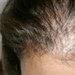 Best Alopecia Center in Islamabad