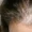 Causes of Frontal Fibrosing Alopecia