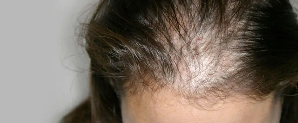 Best Alopecia Center in Islamabad