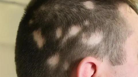 Causes of Frontal Fibrosing Alopecia