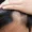 Early Frontal Fibrosing Alopecia