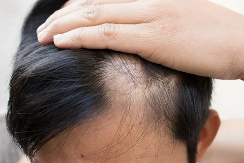Early Frontal Fibrosing Alopecia