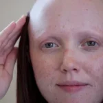 HRT and hair loss in women