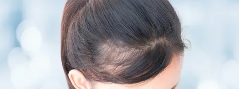 HRT and hair loss in women