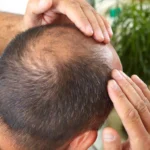 how can men regrow thinning hair