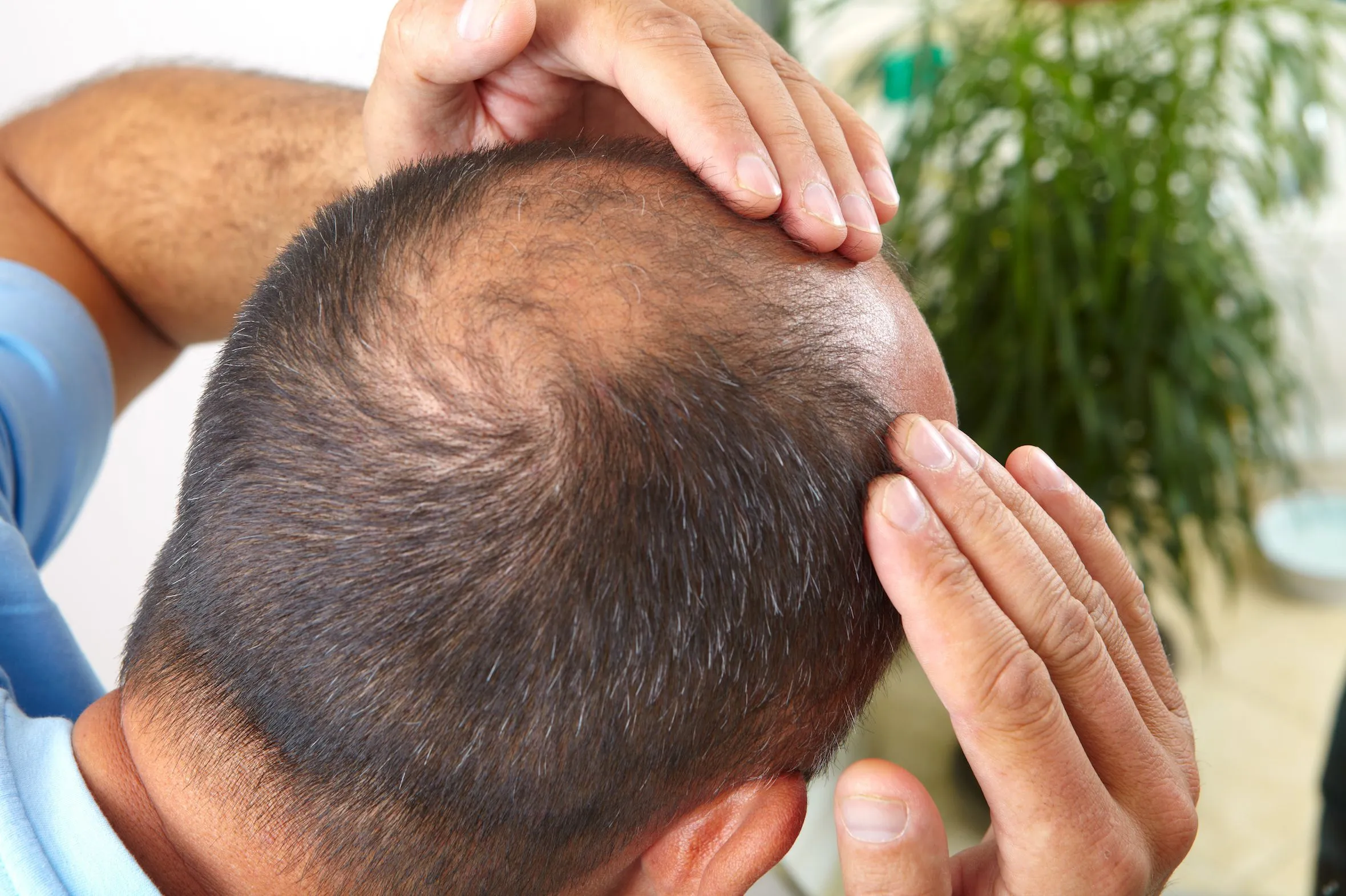 how can men regrow thinning hair