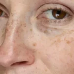 HydraFacial benefits for pigmentation