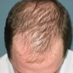 Is It Possible to Grow Back Thinning Hair