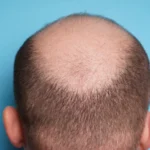Is balding at 25 normal
