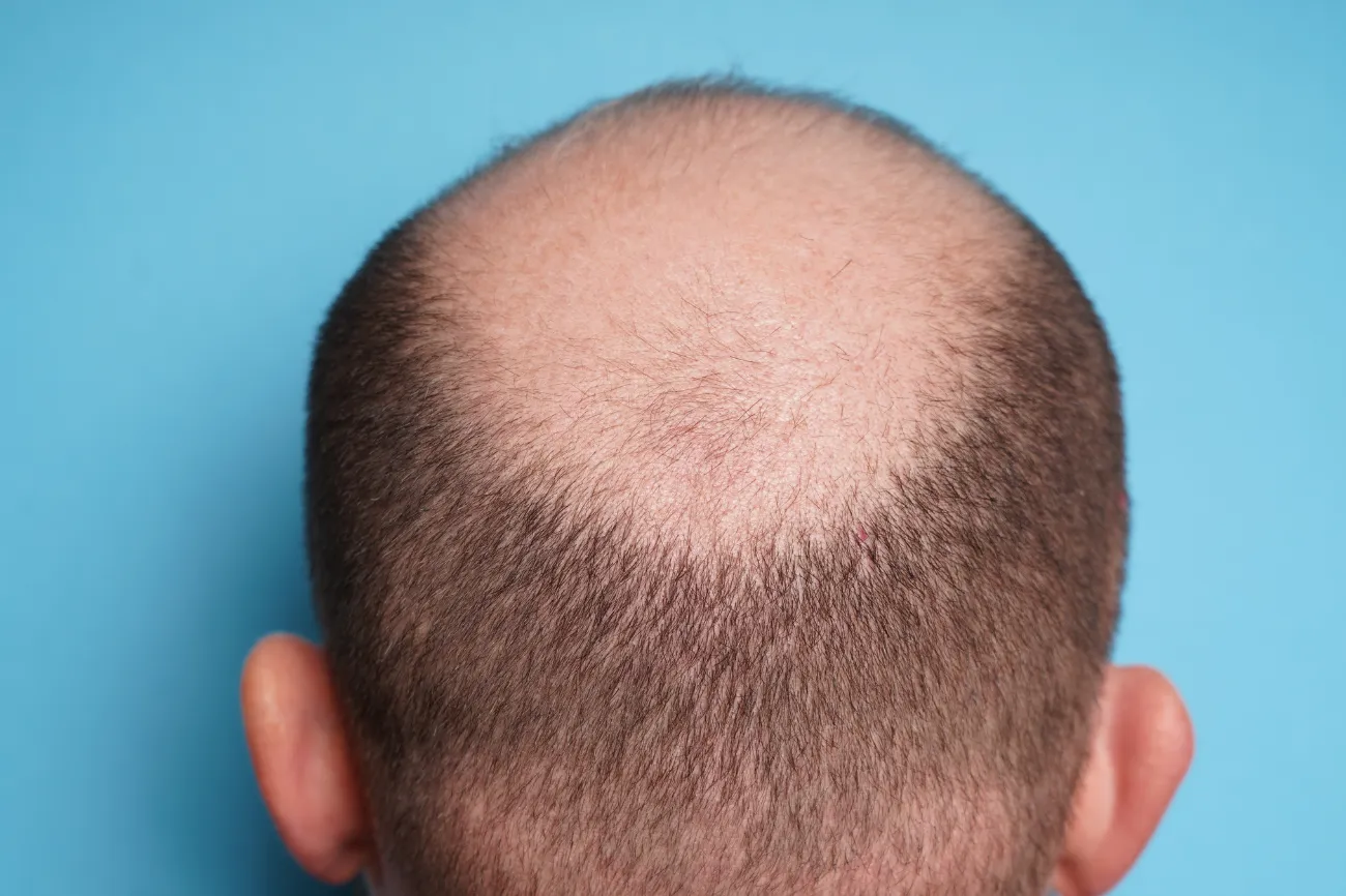 Is balding at 25 normal