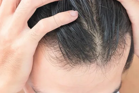 Is thinning of hair permanent