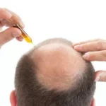 the No. 1 treatment for hair loss