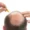 the No. 1 treatment for hair loss