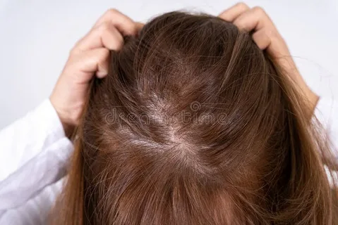 What is Stage 3 hair thinning