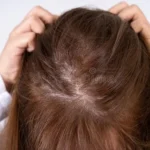 What is Stage 3 Hair Thinning