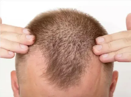What is the Big 3 for hair loss