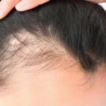 Why is my hair thinning at 18 (female)