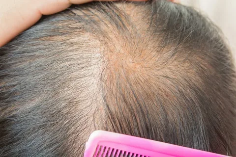 Why Is My Hair Thinning at 18 (Female)
