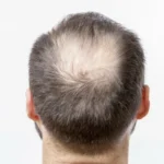 Why is my hair thinning at 18 (male)?