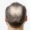 Why is my hair thinning at 18 (male)?