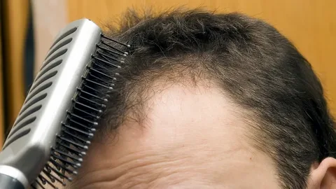 Why is my hair thinning at 18 (male)