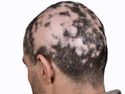 topical treatments for alopecia