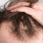 Expert Dermatologist for Alopecia