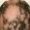 alopecia areata how to diagnose alopecia topical