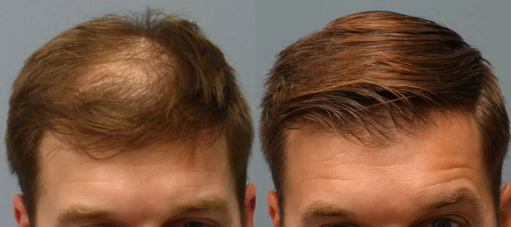 Hair Specialist for Alopecia