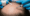 Corticosteroids for Alopecia Areata Treatment