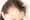 Can Frontal Fibrosing Alopecia Be Reversed